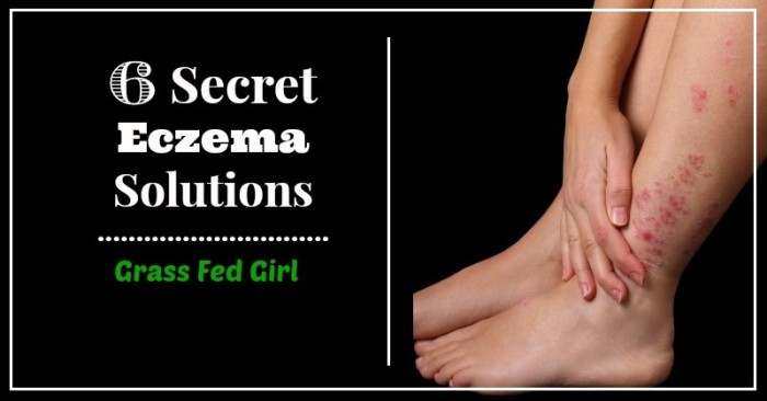 eczema solutions