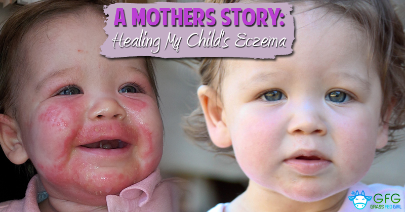 Using The Paleo Diet To Heal Eczema And Dermatitis In Children Grass Fed Girl